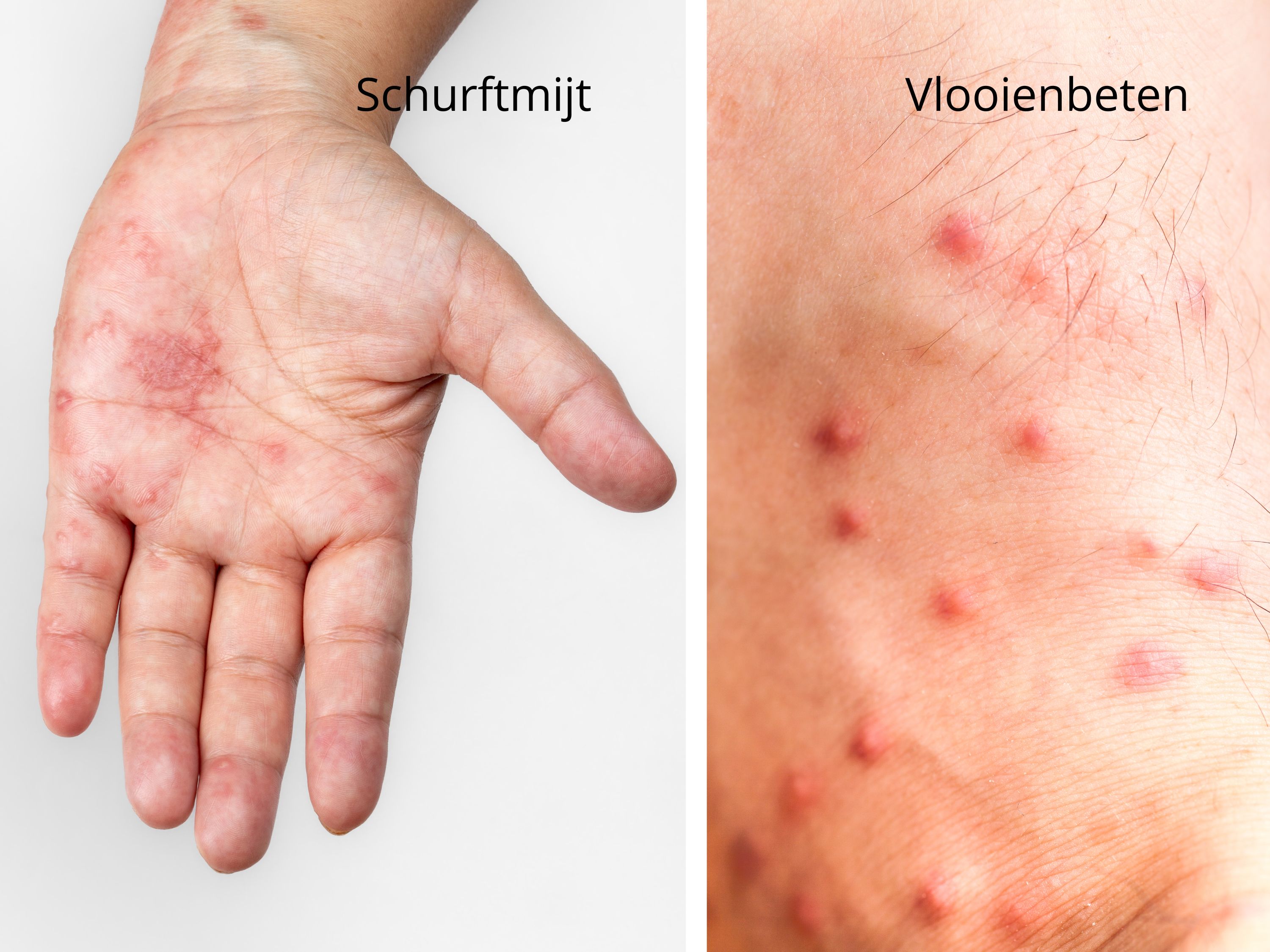 Schurftmijt en vlooienbeten herkennen